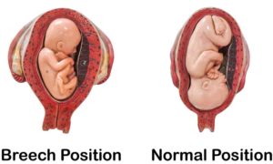 Condition-Specific-Pages_Acetabular-Dysplasia_Baby-in-Uterus-300x180