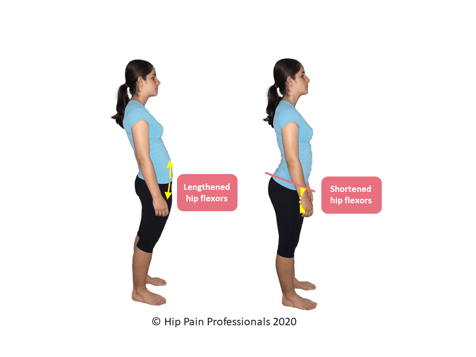 Long or short hip flexors can both contribute to hip flexor related hip pain