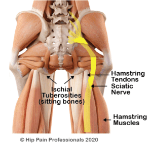 Sciatic-Nerve-Relationship-with-PHT_small-300x291